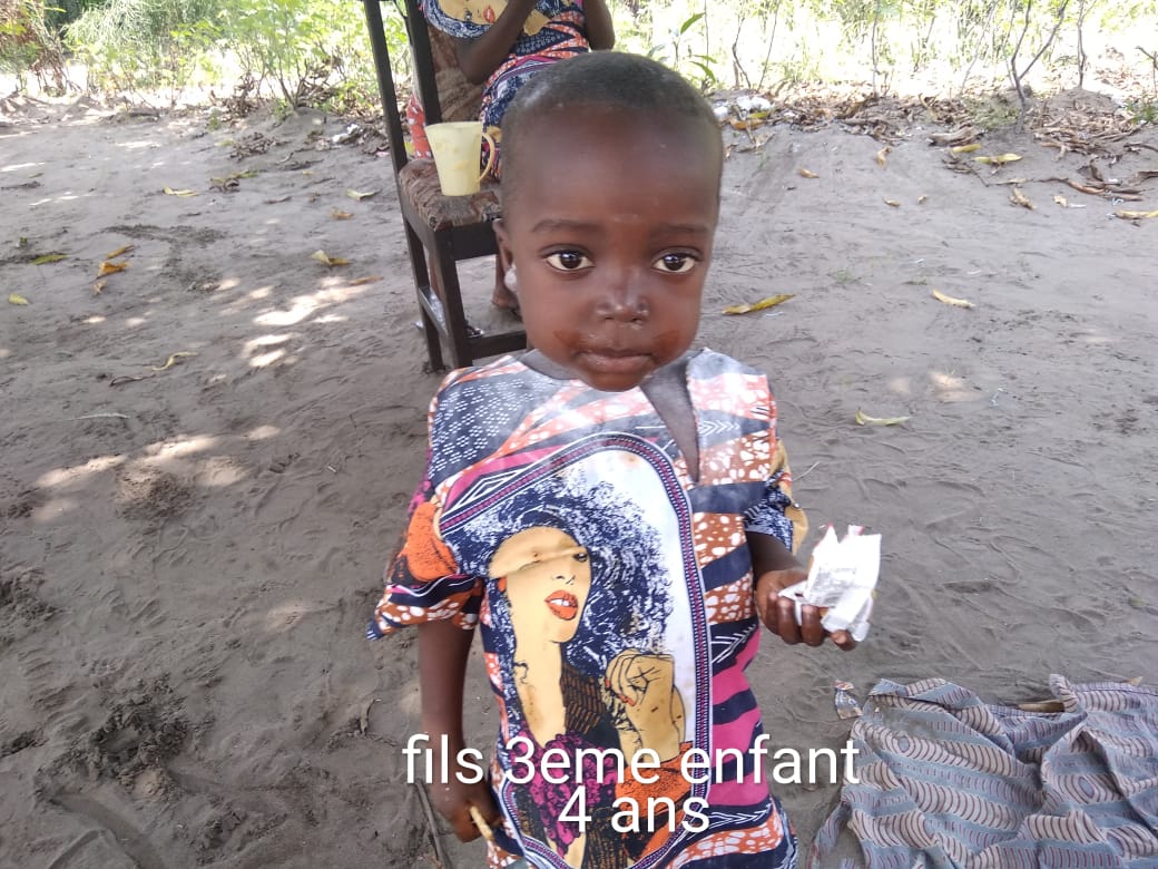 Un enfant victime de la malnutrition au Centre Mère de NSELE avec des signes de la guerison totale